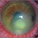 A typical example of what the eye looks like when the cornea is infected